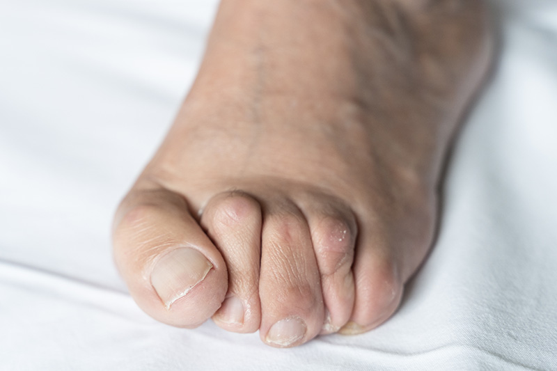 Foot with hammertoe deformity showing curled toes that may cause pain, discomfort, and mobility issues.