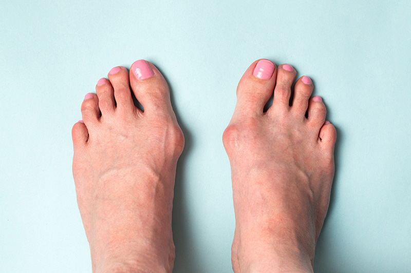 Feet showing bunions near the base of the big toes, a common foot deformity that can cause pain and discomfort.